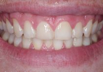 After - Springburndental