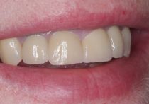 After - Springburndental