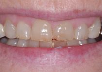 Before - Springburndental