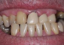 Before - Springburndental