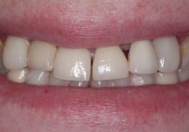 Before - Springburndental