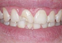 Before - Springburndental