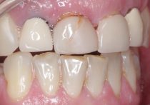 Before - Springburndental