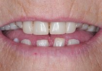 Before - Springburndental